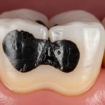 Tooth Broke in Half Black Inside No Pain